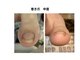 巻き爪補整店 桜庵の写真/高い技術力で痛みが少ない!美しさまで叶える巻き爪補整の凄腕施術者が対応