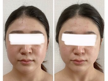 うつくし痩身 美サロン ゼットワン(Z-ONE)/１回　before　after