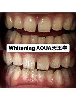 アクア 天王寺店(AQUA)/セルフホワイトニング/天王寺