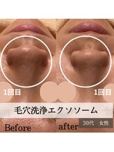 パルティノ 高崎店/毛穴洗浄エクソソーム