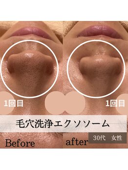 パルティノ 高崎店/毛穴洗浄エクソソーム