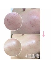 エヌエー 米子店(na)/肌質改善・赤ら肌・乾燥肌