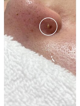 毛穴塾/毛穴パックで浮き出る角栓