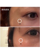 モアビューティー 紙屋町店/The Whiteout 【シミケア】