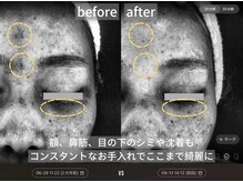 シミケアも効果をご実感いただいています。