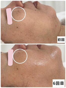 ベルエクラ(Bel Eclat)/頬のモヤモヤ・フェイスライン