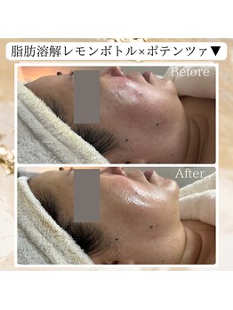 ビヌ(Binu)/脂肪分解レモンボトル・小顔ケア