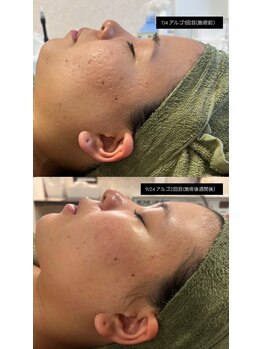 ビューティービューティー(beauty×beauty)/ハーブピーリングお客様結果