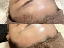 アルム(a'lm)/フェイシャルワックス/生え際WAX