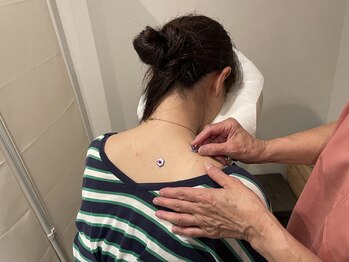 武蔵新城きんとれ治療院/お灸