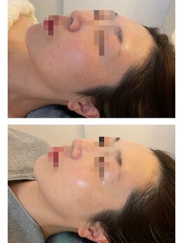 ペルナ(perna)/ハーブピーリング／ツヤ肌