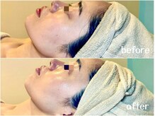 サロン ド ブラン アオヤマ(Salon de BLANC AOYAMA)/クリスティーナ美白ケア