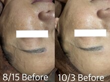 ディアーム 光明池店(Diarm)/陶肌ピール3回施術前お肌の比較