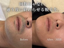 ダイヤ 名古屋中川区店(Daiya)/メンズ脱毛/ヒゲ【BeforeAfter】