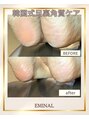 エミナル 恵比寿(EMINAL)&nbsp;角質除去