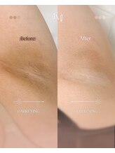 エルビービュティーサロン(LB BEAUTY SALON)/【ルメラ乳輪】実績数関西1★