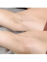 シュクル(SUCRE)/メンズ脇　シュガーリング