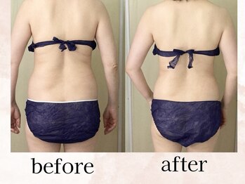 ヒトハナ(hitohana)/一度の痩身で、かなりスッキリ！