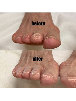 石山整骨院/巻き爪症例
