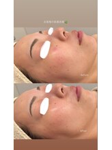 レヴィア 高岡店(REVIA)/肌質改善/ララピール/毛穴ケア