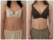 美人バスト 南森町店/バストアップ ◇症例◇