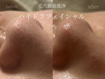 キアラ(CHIARA)/ハイドラフェイシャル