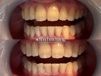 ココロビューティーギャラリー 武蔵小杉(cocorobeauty gallery)/初めてのホワイトニング★