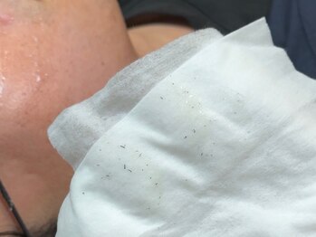 メンズ脱毛サロン ボス(BOSS)/【メンズ脱毛/ヒゲ脱毛全体】