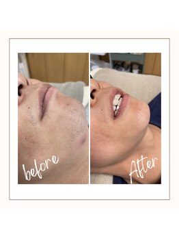 フルールスレーヌ(Fleur Sereine)/清潔感が一番☆本気の髭脱毛