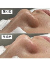 メンズー(MENZOO)/毛穴クリーンケア