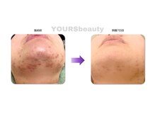 ユアーズ ビューティー(YOURS beauty)/オーダーメイドハーブピーリング