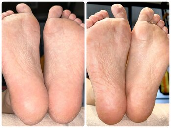 コード(CODE)/角質ケア