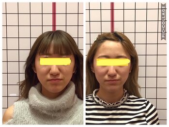 堺整骨院 小郡院/小顔矯正