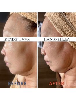 カウピリ(kaupili)/レモンボトル◇ビフォーアフター