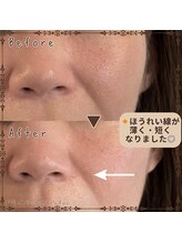 プライベートサロン レイ(Ray)/ほうれい線が薄く◎