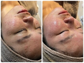 ベルーチェ(Beluce)/20代女性/ニキビケア2回