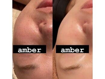 アンバー(amber)の写真/【肌質改善】ハーブピーリングでスッピン自慢の美肌へ♪ヒト幹細胞導入でハリツヤUP！