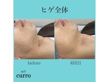 アクト クロ(ACT curro)/【ヒゲ全体】脱毛施術例