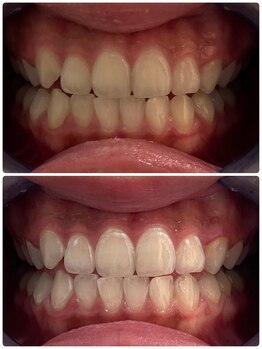 ユーラボ 表参道(YOU-LAB)/Befor/After【ホワイトニング】