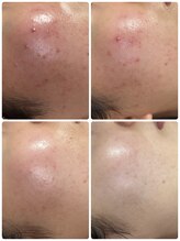 リノ(Lino)/プラズマニア