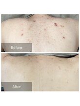 ビビ(VIVI)/ララピール・ハーブピーリング