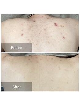 ビビ(VIVI)/ララピール・ハーブピーリング