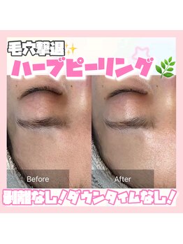 ホワイトアクア 岐阜店(WHITE AQUA)/ハーブピーリング/岐阜/毛穴