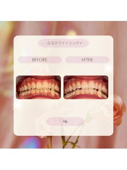 プラスビー 2号店(+b)/ホワイトニングビフォーアフター