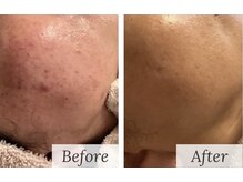 クロア ナゴヤ(Croire NAGOYA)/光フェイシャル/シミケア/美白