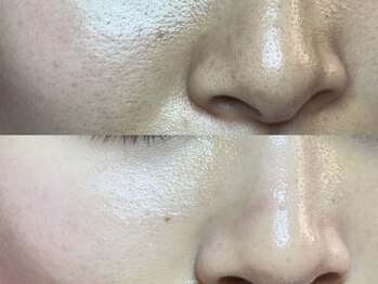 エミュ(emu)/毛穴×ハーブで艶肌