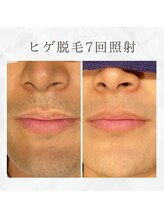 ボゴス(BOGOSS)/ヒゲ脱毛7回照射