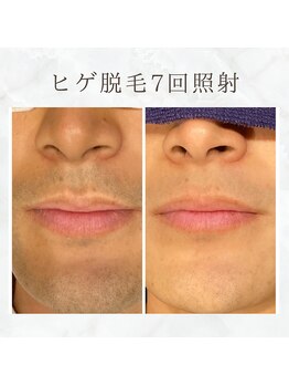 ボゴス(BOGOSS)/ヒゲ脱毛7回照射