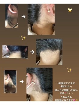 リアンジェ(Lianje)/うなじ脱毛　1年間で6回の結果