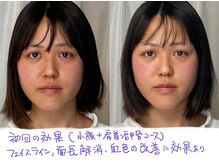 美容整体 アルマ/1回目の効果